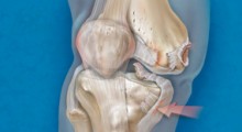 Knee Dislocation Illustration