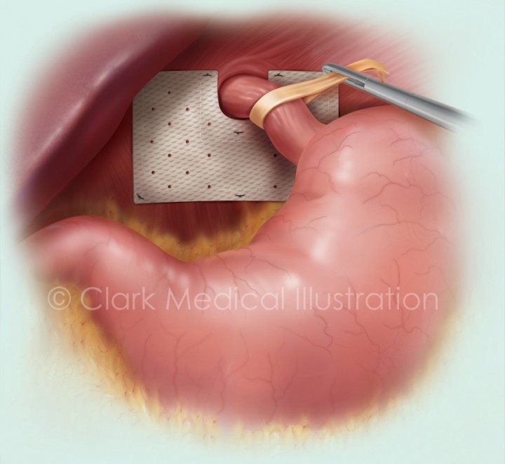 Hiatus Hernia Diet After Surgery