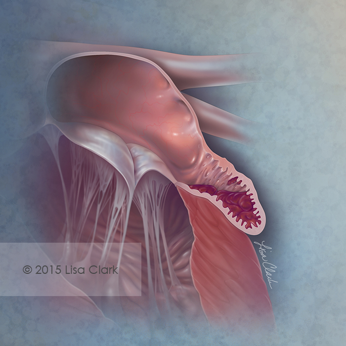 Left Atrial Appendage Thrombus – Artists' Blogs :: Medical Illustration