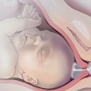 Cervical Ripening Balloon for Labor Induction