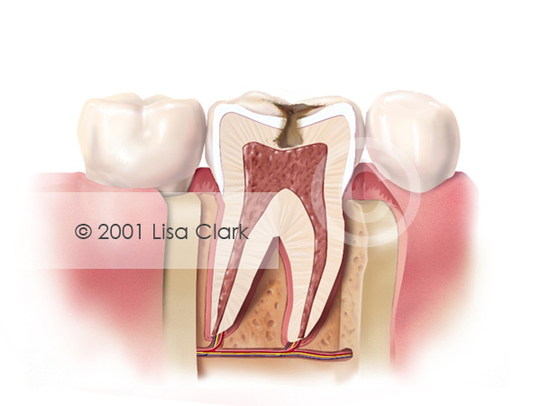 Dental Fillings 2: Progressive Tooth Decay (Cross Section)