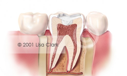 Dental Fillings 2: Basing Material