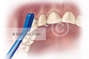 Dental Home Care: Proxi-brush Properly Placed Between Teeth