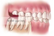 Impacted Wisdom Tooth: Soft Tissue Impacted