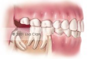 Impacted Wisdom Tooth: “Distally” Impacted