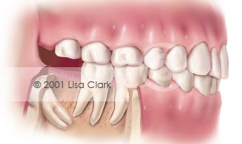 Impacted Wisdom Tooth: “Distally” Impacted