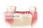 Dental Implant: Good Bone Support Below Gingival Tissue