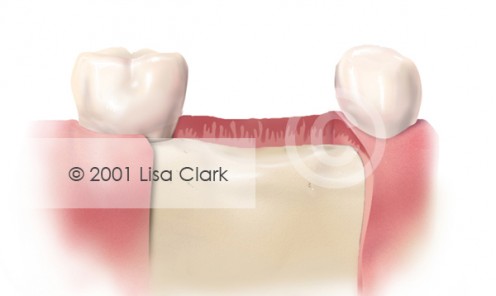 Dental Implant: Good Bone Support Below Gingival Tissue