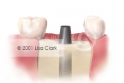 Dental Implant: Implant in Bone