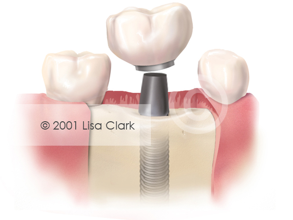 Dental Implant: Crown near Final Position