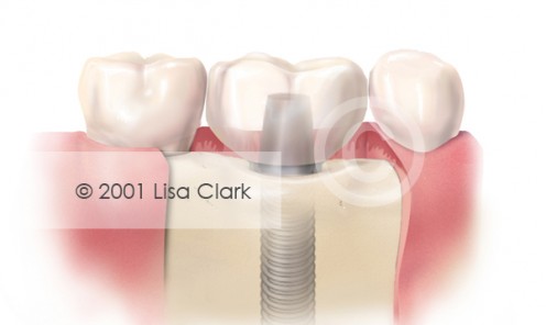 Dental Implant: Crown in Final Position