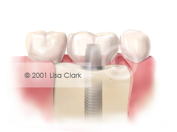 Dental Implant: Crown in Final Position