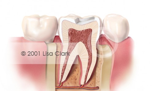 Dental Inlay: Tooth prepared for Inlay