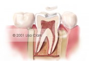 Dental Inlay: Inlay Near Final Position