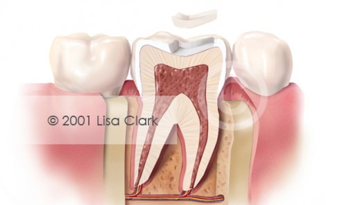 Dental Inlay: Inlay Near Final Position