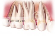 Periodontal 3: Increased Changes in Bone Architecture