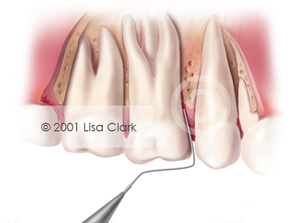 Periodontal 2: Periodontal Probe (Gums Removed)