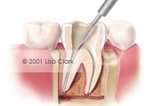 Root Canal: Pulp Removed