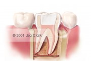 Root Canal: Final Filling (White Material)