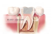 Root Canal: Final Filling (Silver Material)