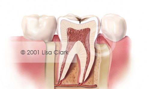 Dental Fillings 1: Progressive Tooth Decay