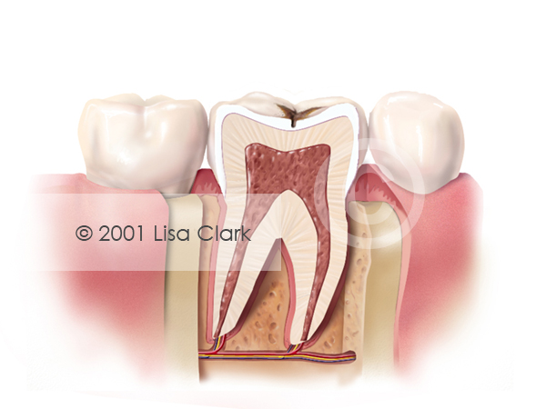Dental Fillings 1: Progressive Tooth Decay