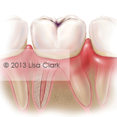 Dental Caries (Cavities)