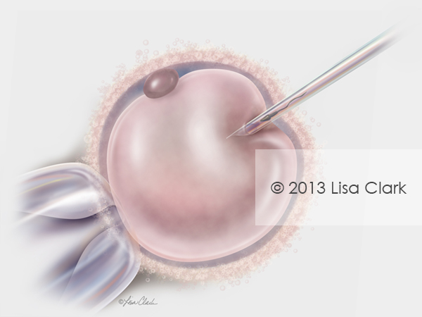 Intra-Cytoplasmic Sperm Injection (ICSI) Illustration
