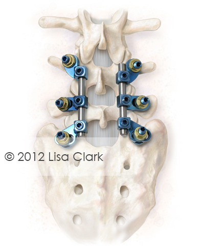 Lumbar Spinal Implant Illustration