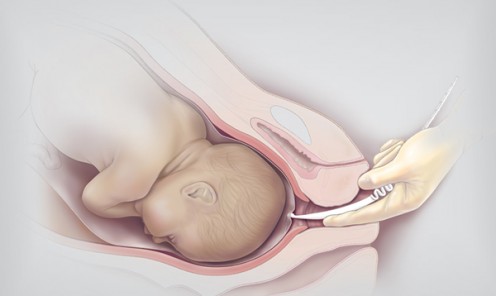 Amniotic Membrane Perforator illustration