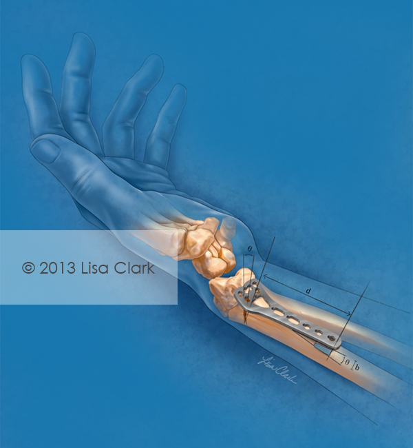 Radial Fracture Plate Illustration