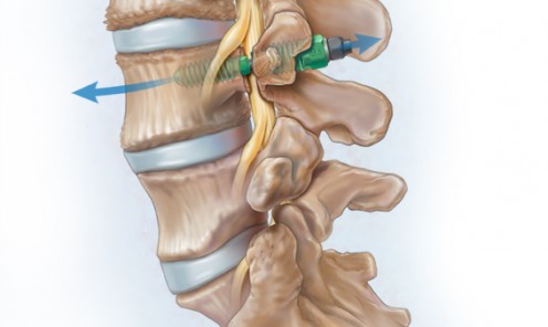 Spinal Stenosis Device