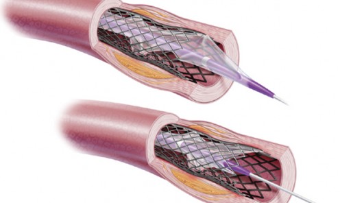 Stent Balloon Removal Issues