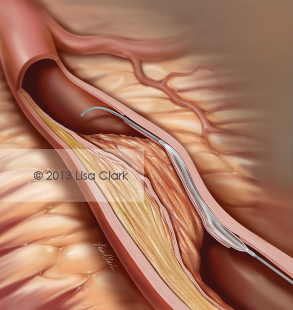 Percutaneous Coronary Intervention Illustration