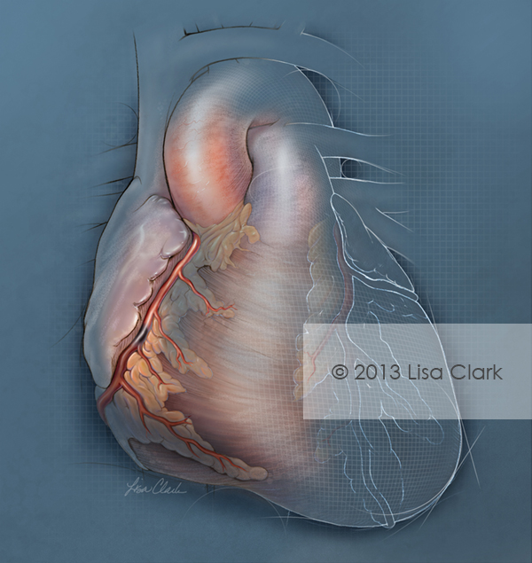 Percutaneous Heart Failure Illustration