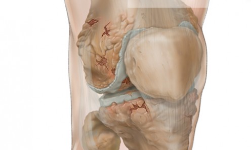 Severe Osteoarthritis of the Knee