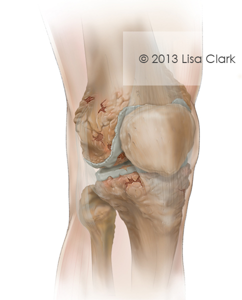 Advanced Osteoarthritis of the Knee