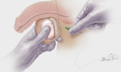 Testicular Sperm Aspiration (TESA)