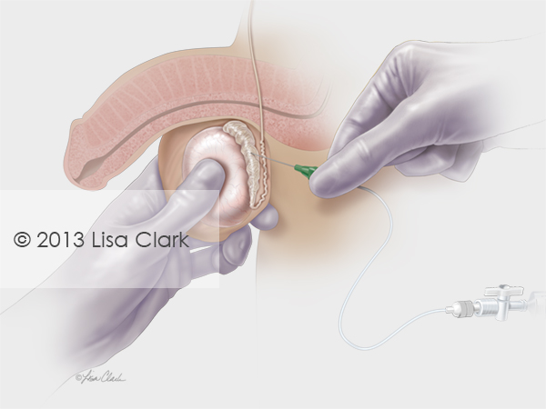 Testicular Sperm Aspiration (TESA) Illustration