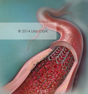 Coronary Artery Stent Illustration