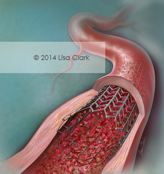 Coronary Artery Stent Illustration