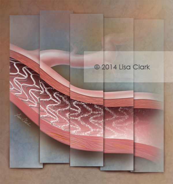 Dissolving stent illustration. © Lisa A. Clark