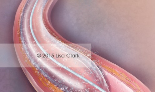 Drug Eluting Angioplasty ©2015 Lisa A. Clark