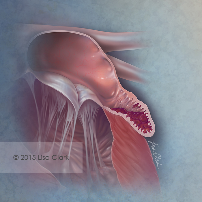 Left Atrial Appendage Thrombus ©2015 Lisa A. Clark 