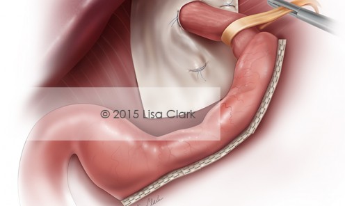 Laparoscopic Sleeve Gastrectomy (LSG) ©2015, Lisa Clark
