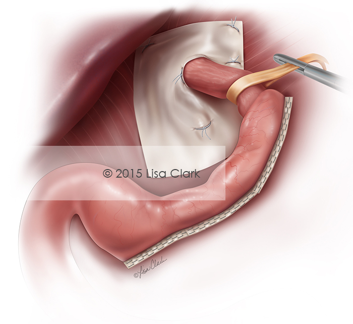 Laparoscopic Sleeve Gastrectomy (LSG)  ©2015, Lisa Clark