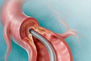 Catheter-Directed Atherectomy | © Lisa A. Clark