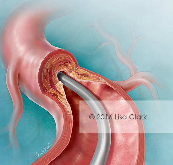 Catheter-Directed Atherectomy Illustration