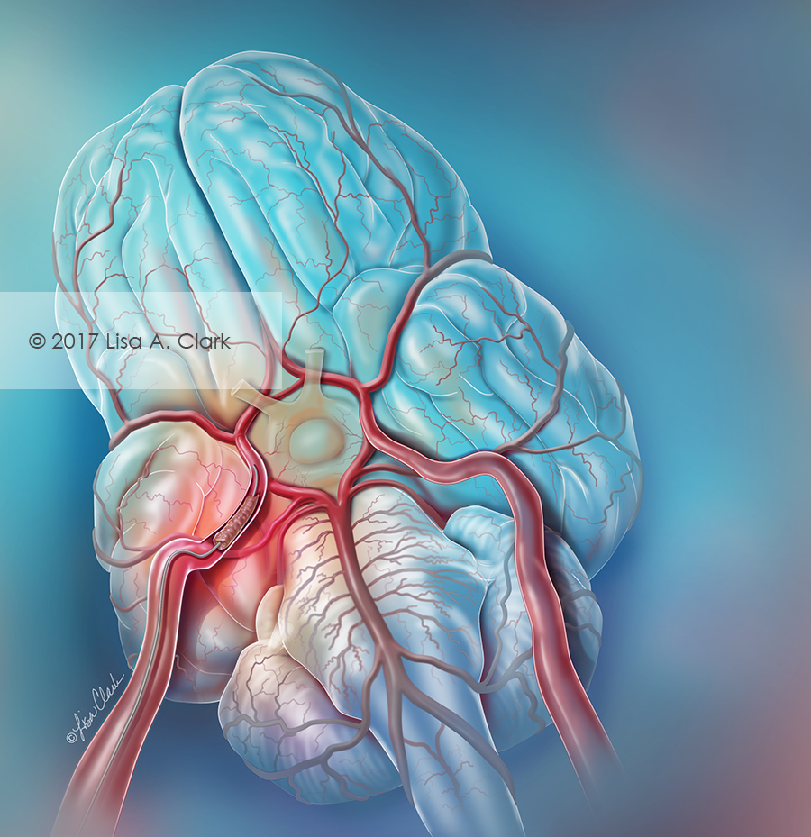 Endovascular thrombectomy illustration