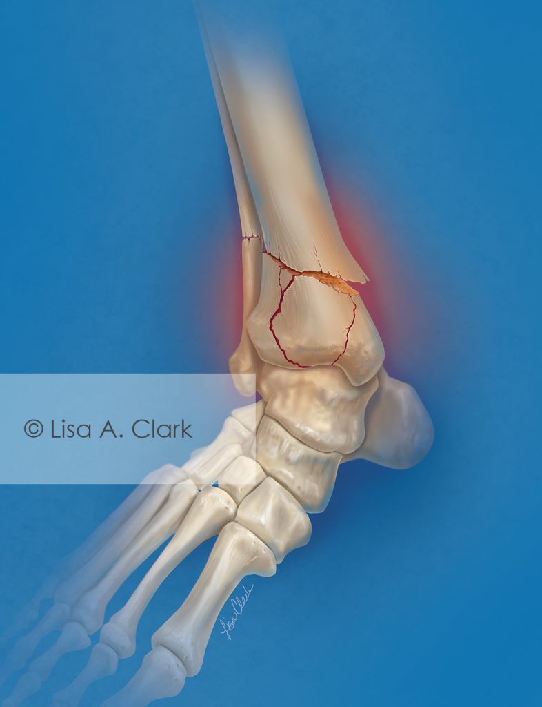 Ankle Fracture | © Lisa A. Clark